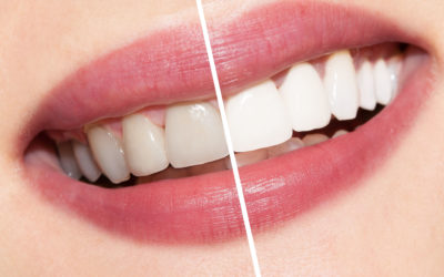 Tooth Discoloration: Common Causes and What You Can Do To Stop It
