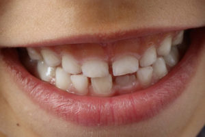 How Fast Does a Cavity Form? - Dentistry For Kids And Adults