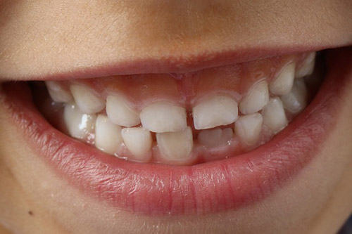 cavities in baby teeth