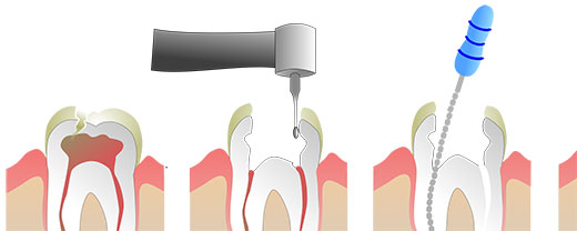 Root-Canal-Treatment,-Dentistry-Kids-and-Adults | Dentistry For Kids ...